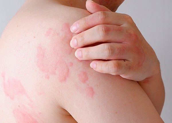 Red hives on his back