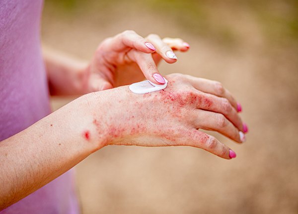 Woman applies cream to eczema on hand