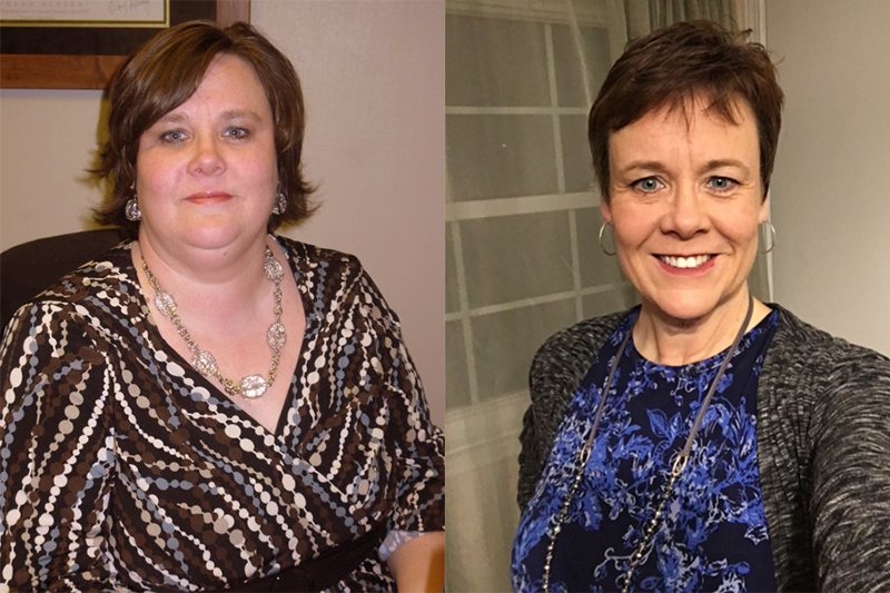 Bariatric Surgery: It’s Not About Giving Things Up