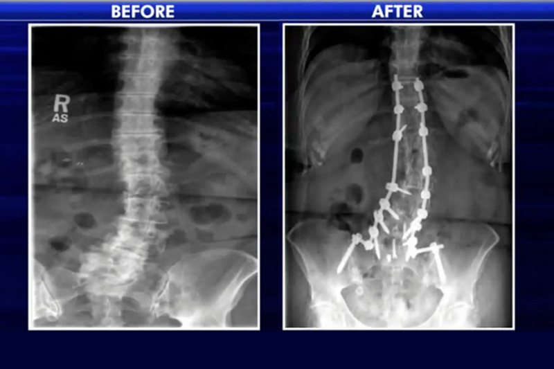 After Spinal Surgery