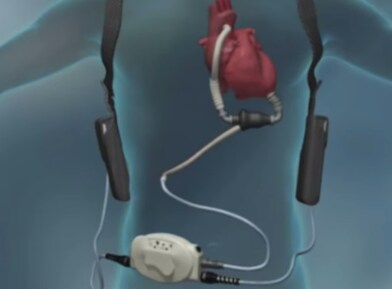 Ventricular Assist Device